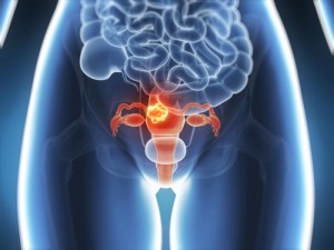 Endometrial cancer is the very frequent cancer of the women reproductive organs in the United States; about 1 in 37 females will be diagnosed with the condition in their life-time.