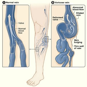 Varicose veins develop when valves of the superficial system are weak or destroyed, blood can back up and pool leads to vein to lose its shape, (Image Credit: National Heart, Lung, and Blood Institute)