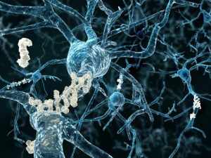 The study suggests it is possible the build up of amyloid clusters within brain cells may play a role to the development of amyloid plaques outside brain cells - one more hallmark of Alzheimer's.