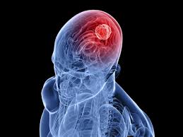 Investigators have identified a way to improve the effects of this therapeutic strategy in glioblastoma, a dangerous kind of brain cancer, and probably enhance patient outcomes