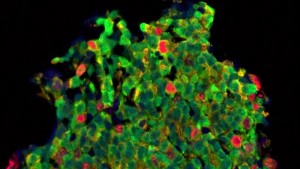 The investigators think their results uncover the new drugs - shown here working towards prostate cancer cells - could possibly be used to deal men with prostate cancers that have turn into resistant to standard treatment. Image credit: Prof. Johann de Bono/ICR